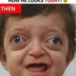 ST, The doctors managed to correct this boy’s face. Just look at how he looks today! 