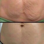 How to Firm Sagging Skin Naturally