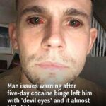 Man issues warning after five-day cocaine binge left him with ‘devil eyes’ and it almost killed him