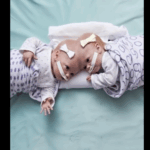 Seven Years After Separation : The Amazing Transformation of Siamese Twins Is Here